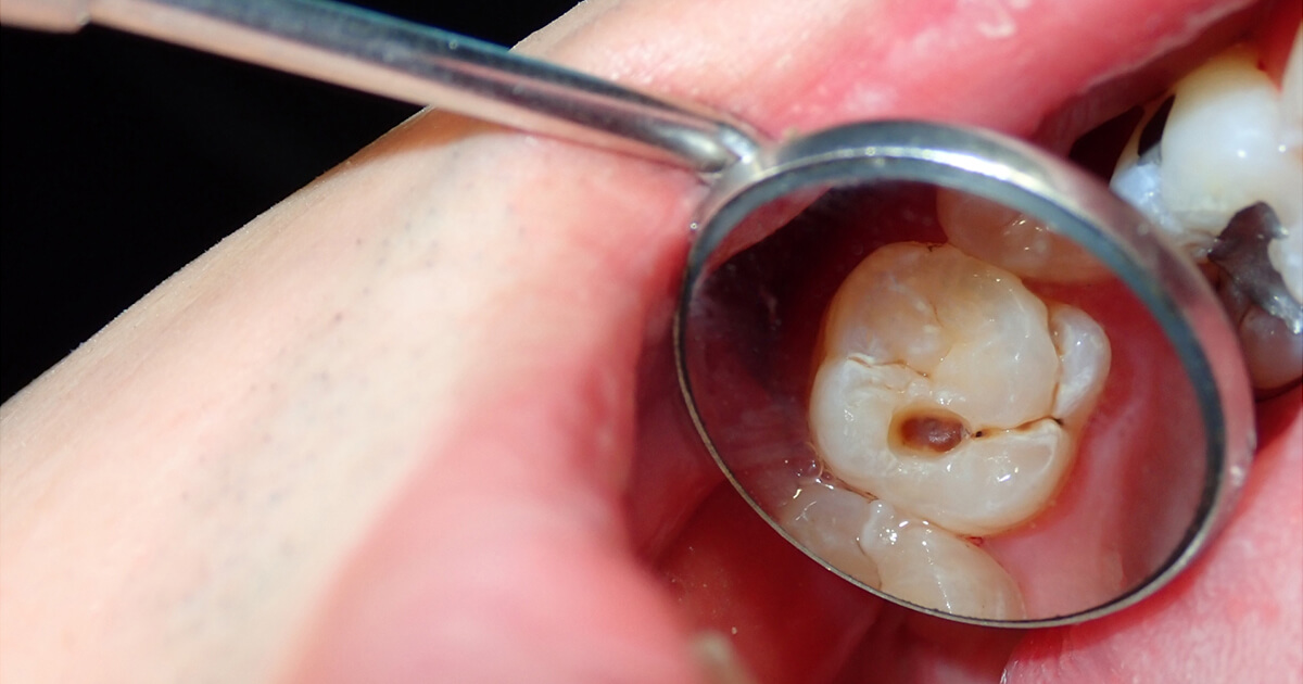 cavity
