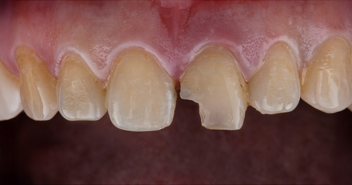 chipped tooth