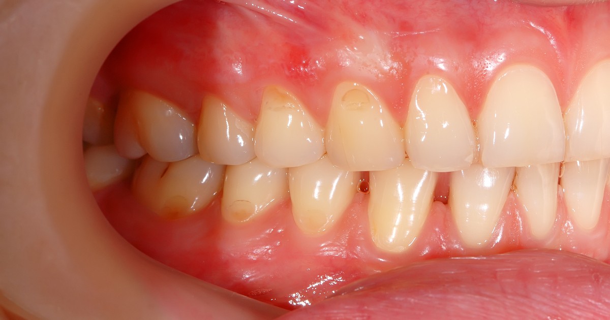 gum recession