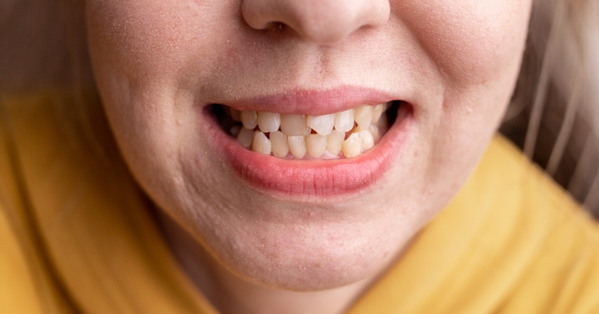 crooked teeth