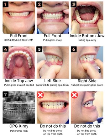 Sample photos of teeth to send for an initial dental implant consultation: front smile, upper and lower teeth