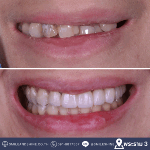 smile makeover bangkok