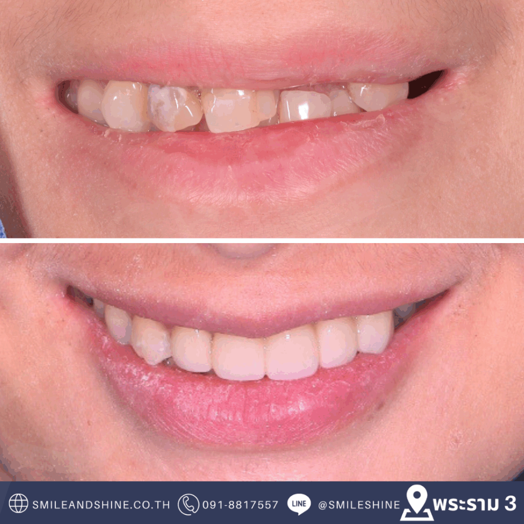bangkok smile makeover