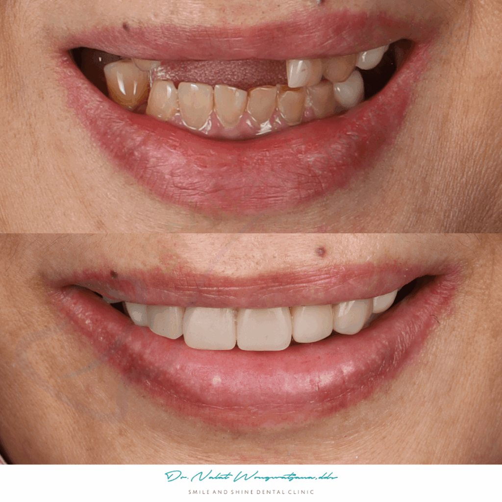 เคสบูรณะฟันปลอมแตก – Smile and Shine Dental Clinic