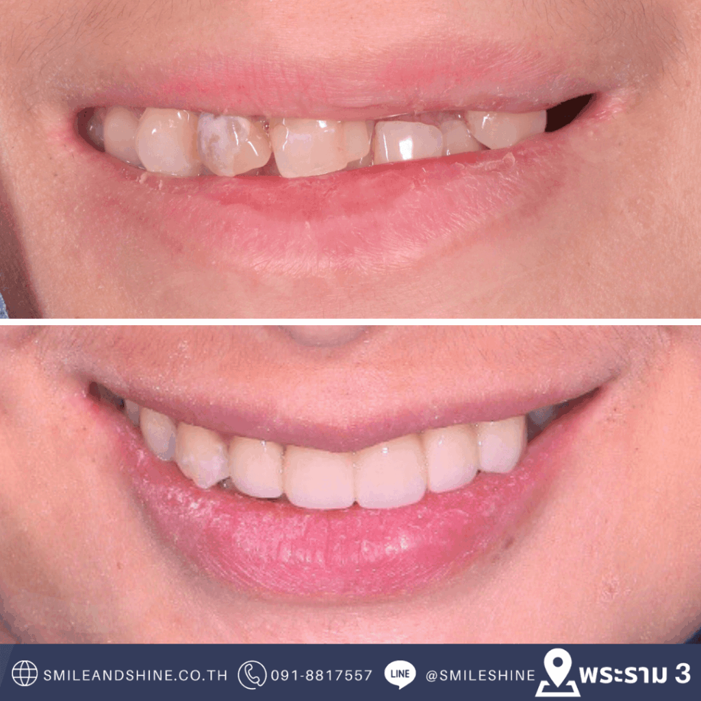 เคสรักษาฟันร้าวและฟันเปลี่ยนสี – Smile and Shine Dental Clinic