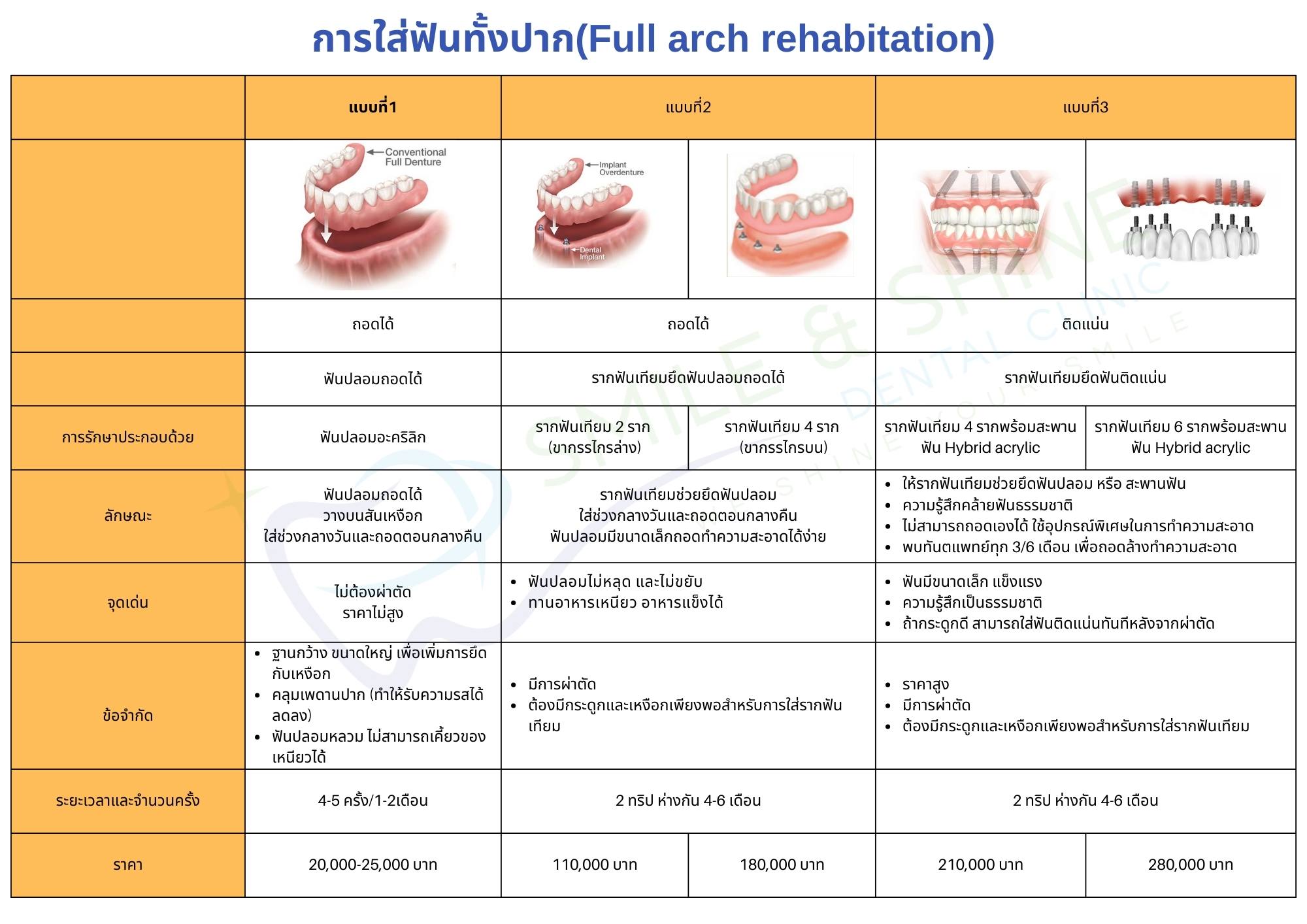 ราคารากฟันเทียม ทั้งปาก