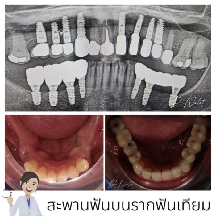 รากฟันเทียมฟันกรามใส่แบบไหน