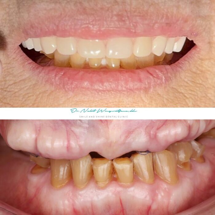 รากฟันเทียมผู้สูงอายุ