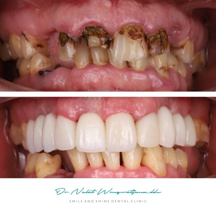 Full mouth rehabilitation case from Smile and Shine Dental Clinic using dental implants and ceramic crowns, combining implant-supported crowns and preserved natural teeth.