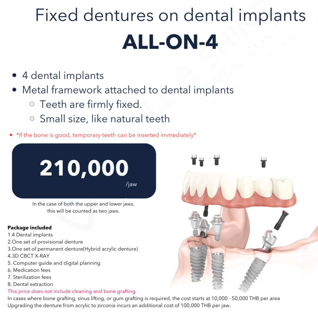 ราคา รากฟันเทียมทั้งปาก