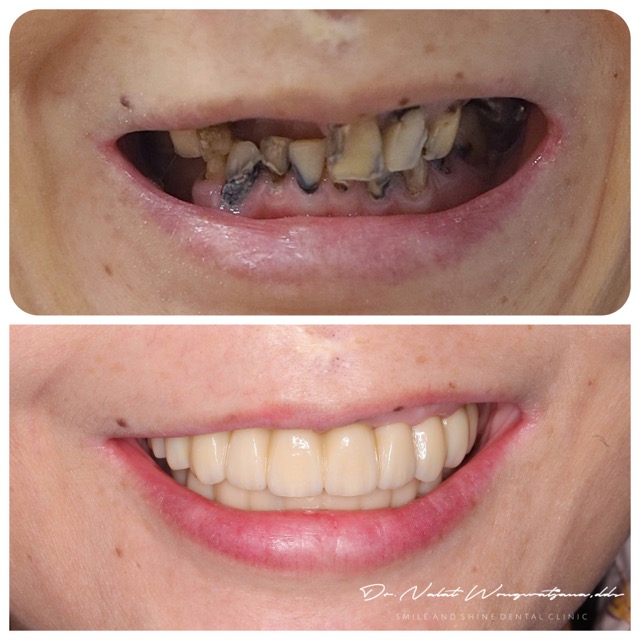ก่อน-หลัง Overdenture Mini Implant ผู้สูงอายุ Smile and Shine