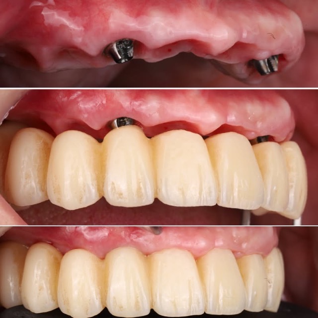 ก่อน-หลัง All-on-4 ฟันทั้งปาก Smile and Shine