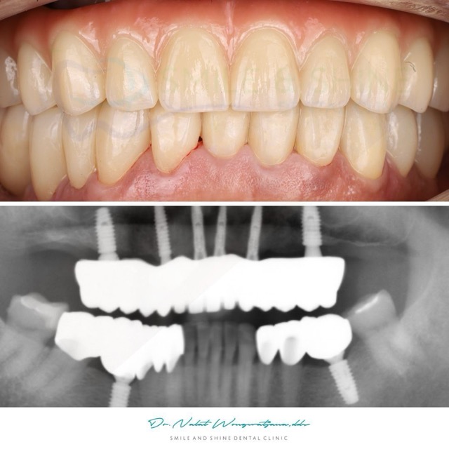 ก่อน-หลัง All-on-6 ฟันทั้งปาก Smile and Shine