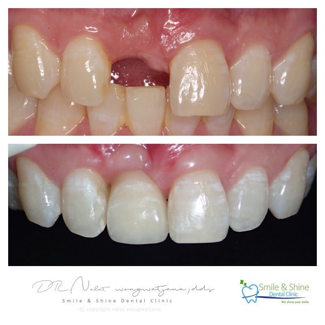 ก่อน-หลังรากฟันเทียม เคส 1 Smile and Shine