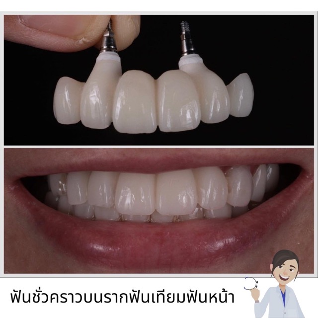 ก่อน-หลังรากฟันเทียม เคส 4 Smile and Shine