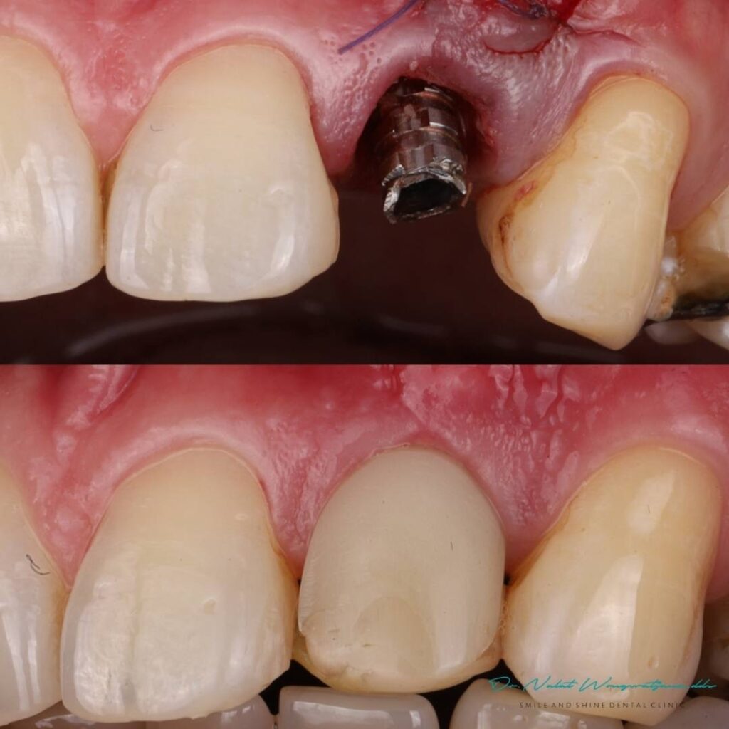 digital guided implant / immediate temporary tooth