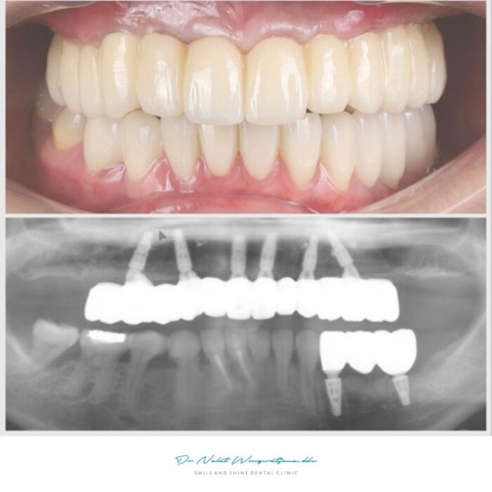 ภาพเอกซเรย์ และ หลังการรักษา all-on-6