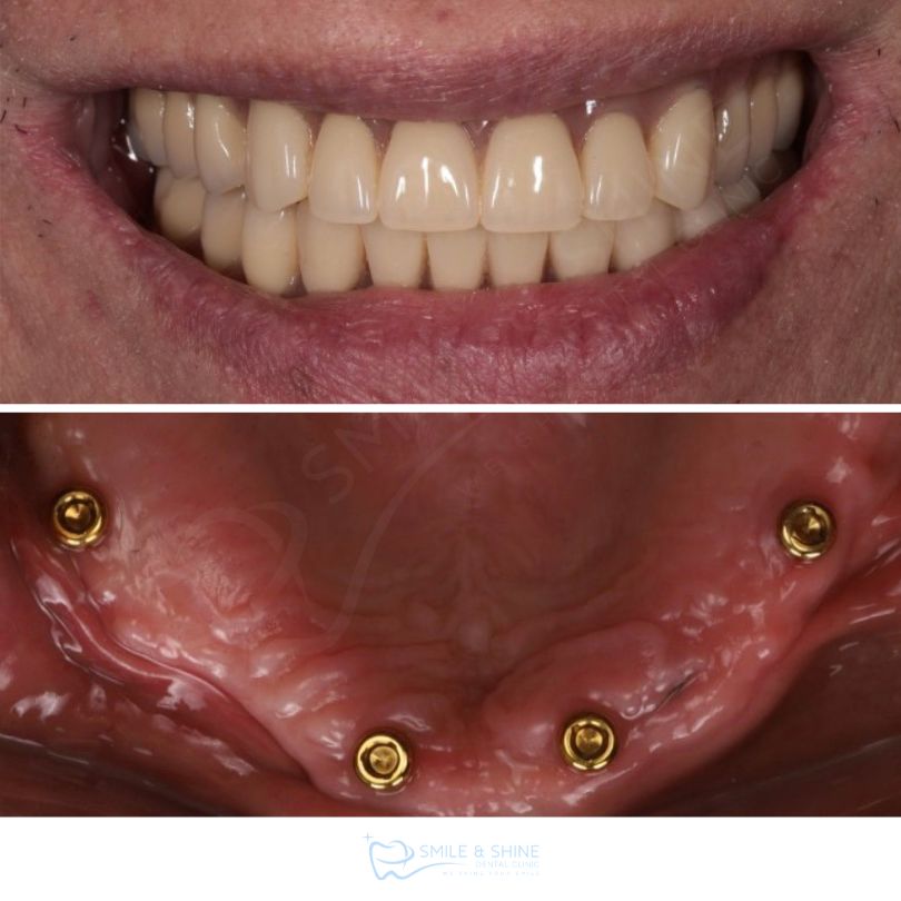 ก่อน-หลัง Overdenture Neo Biotech ผู้สูงอายุ Smile and Shine