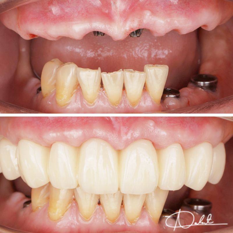 ภาพก่อนและหลังบูรณะฟันทั้งปากด้วยรากฟันเทียม ที่ Smile and Shine Dental Clinic พระราม 3