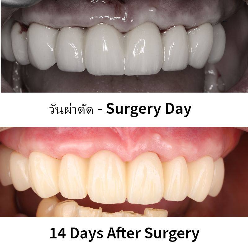 เปรียบเทียบฟันชั่วคราว All-on-X วันผ่าตัดและ 14 วันหลังผ่าตัด
