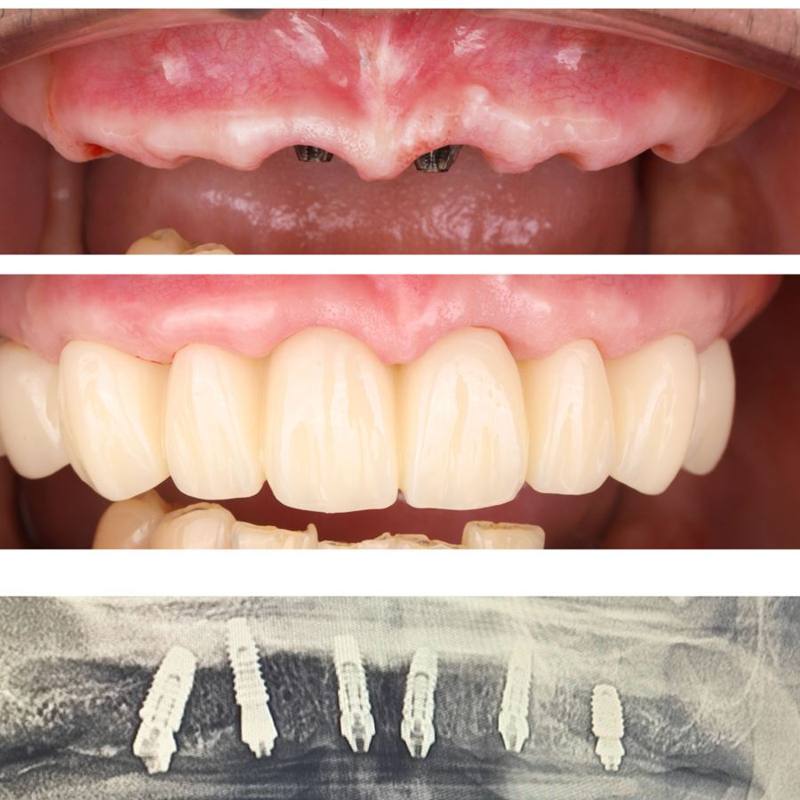 ภาพก่อนทำ ฟันชั่วคราว FP1 และภาพเอกซเรย์รากฟันเทียม 6 รากในขากรรไกรบน