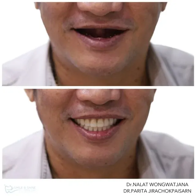 Implant overdenture case before and after treatment at Smile and Shine Dental Clinic Bangkok